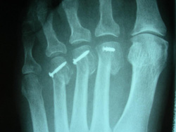 osteotomia