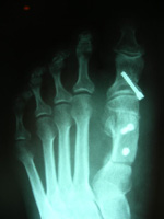 osteotomia_metatarsiano