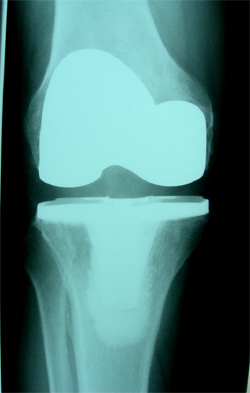 rodilla1