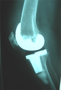 rodilla2