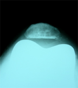 rodilla3